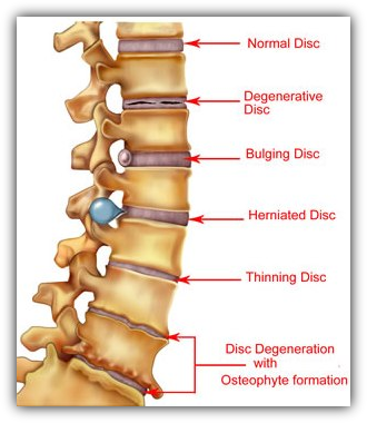 Spinal Chart Discs